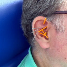 A close up of a man’s ear with three silver acupuncture needles and five acupuncture needles covered in orange plastic stuck in at various angles.